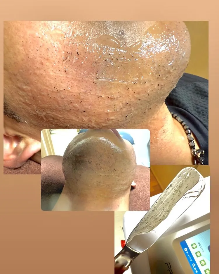 🧔‍♂️ヒゲ脱毛中の「ポップアップ現象」って？🧴✨